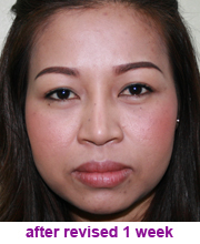 plastic_surgery_augmentation_rhinoplasty